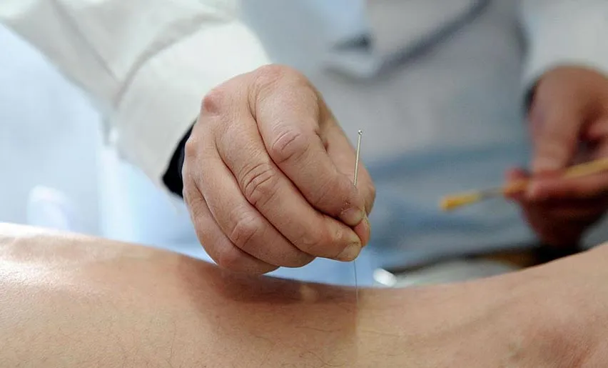 Traditional Chinese Acupuncture